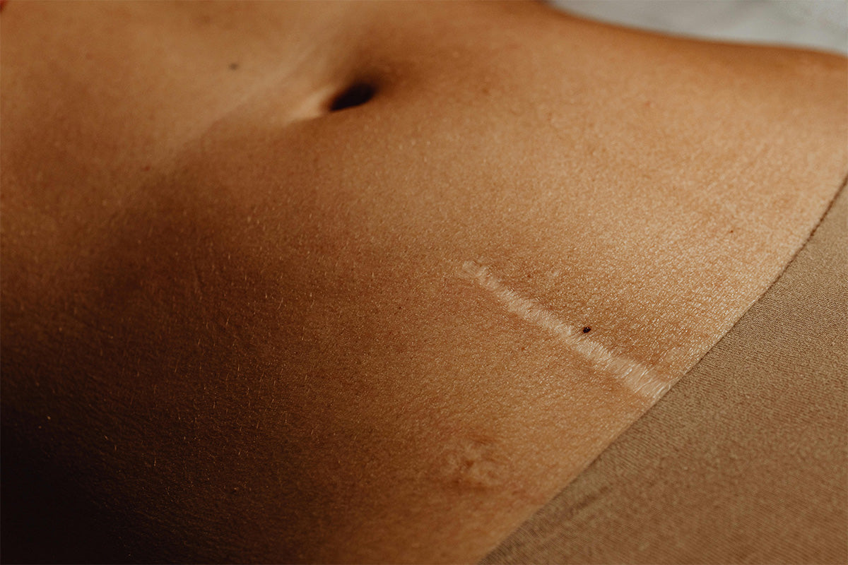 Healing skin after a wound with gentle wound care to fade scars faster