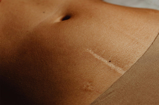 How to Heal Skin Faster After Surgery, Wounds, or Cuts