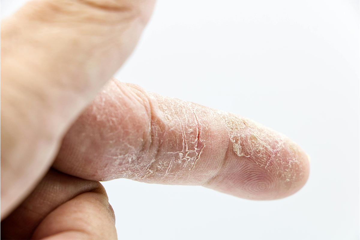 Dry, irritated skin showing signs of a damaged skin barrier on the face