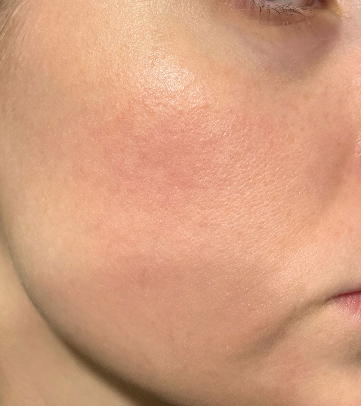 Skin after Sting-Less treatment
