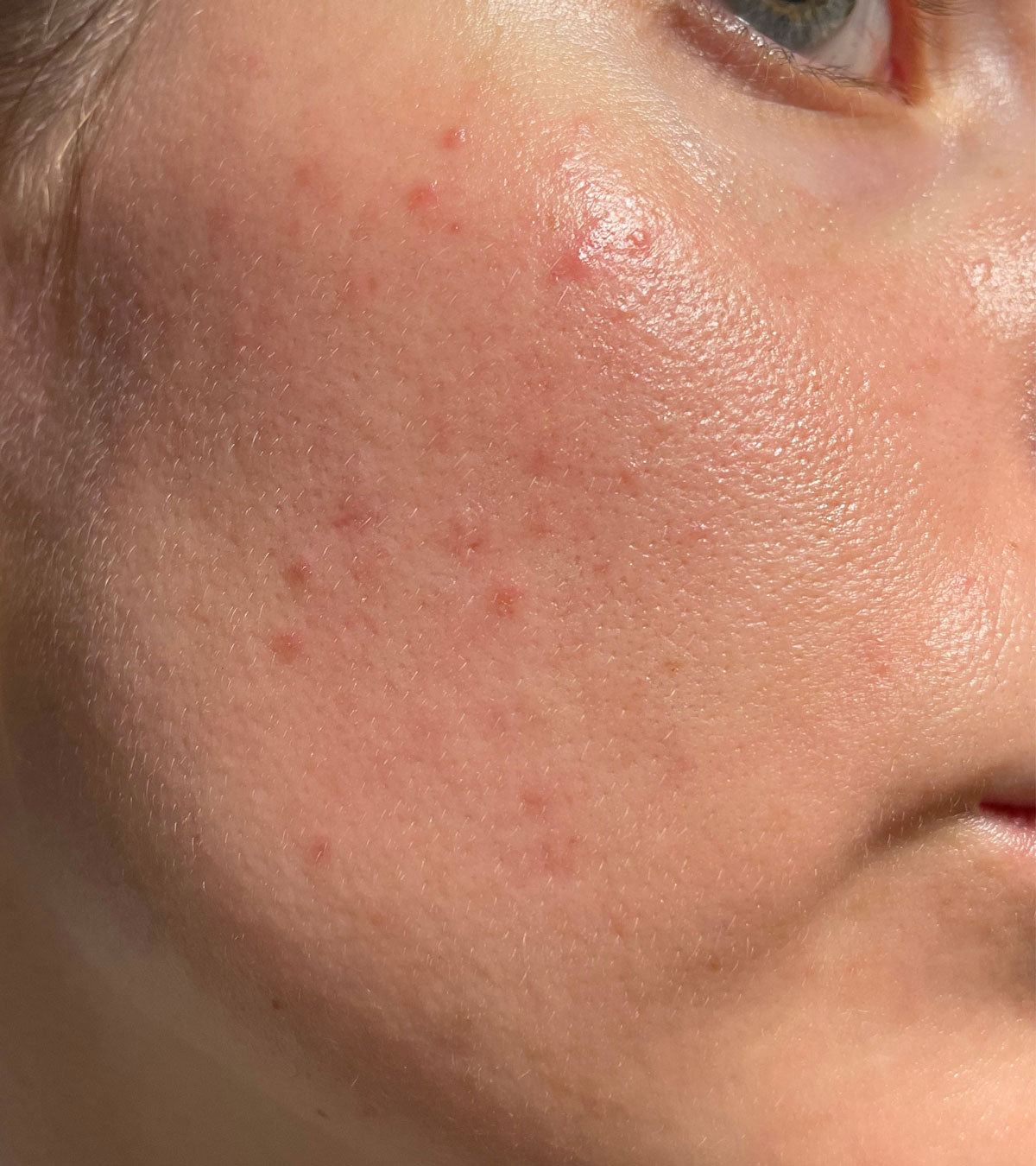 Skin before Sting-Less treatment